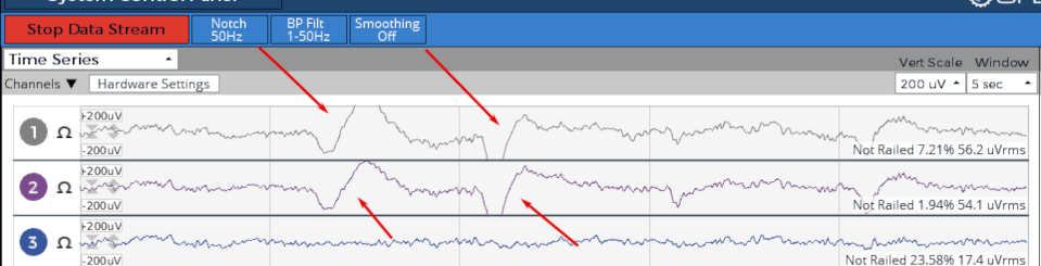 EEG graph showing eye blinks