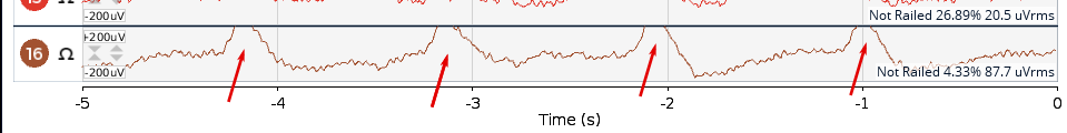 EEG graph showing heart rate